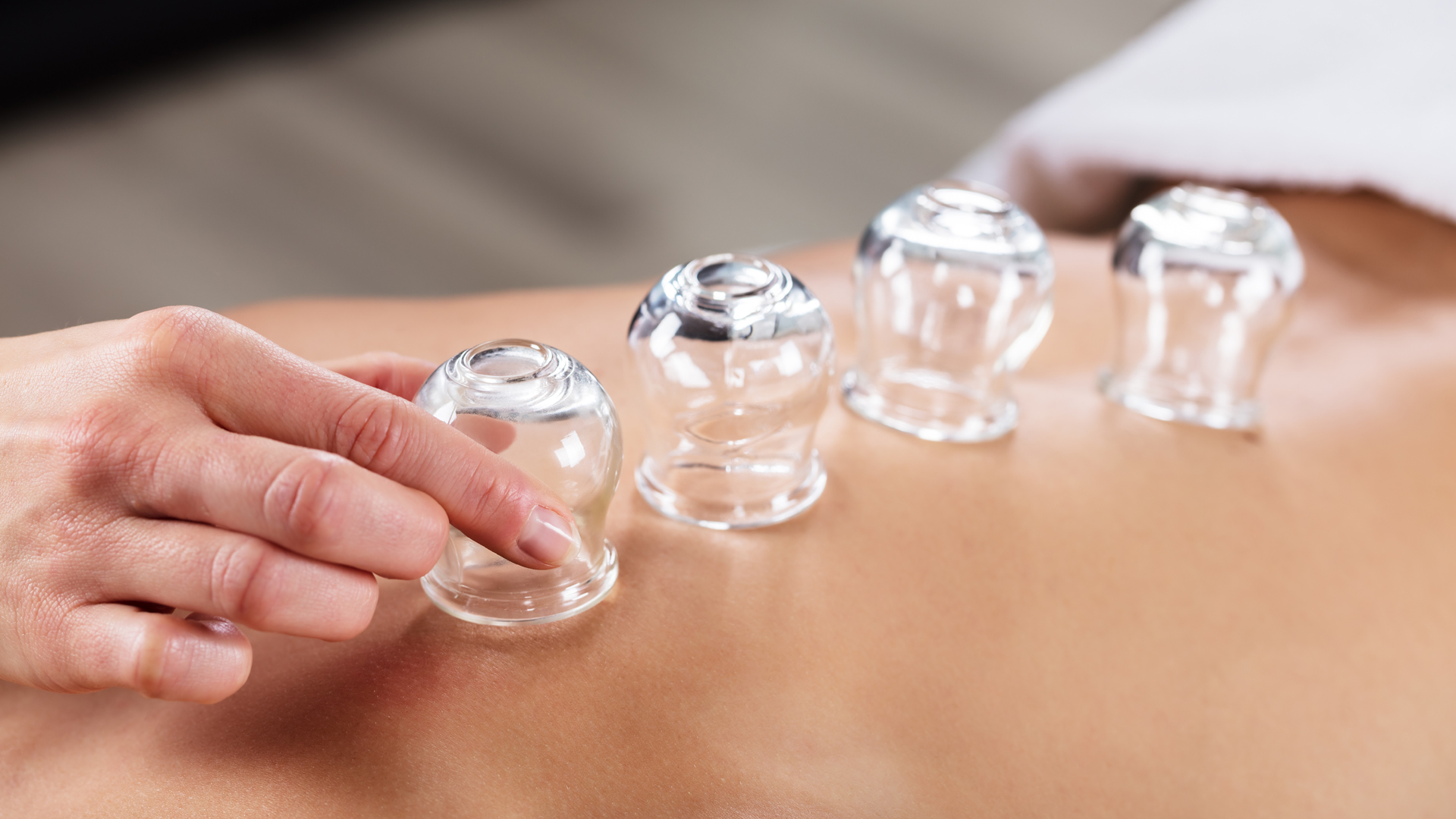 Cupping